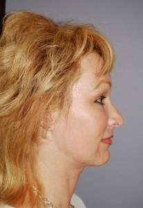 Midfacelift with Nizar Merheb MD