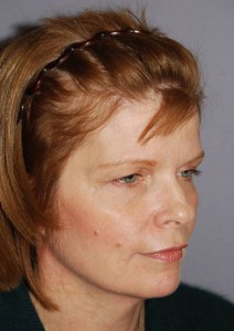 Midfacelift with Nizar Merheb MD
