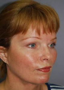 Midfacelift with Nizar Merheb MD