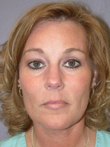 Midfacelift with Nizar Merheb MD