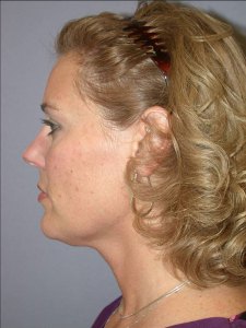 Midfacelift with Nizar Merheb MD