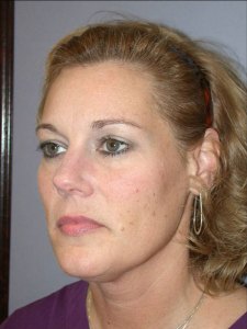 Midfacelift with Nizar Merheb MD