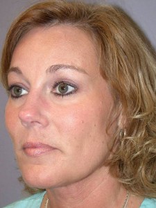 Midfacelift with Nizar Merheb MD