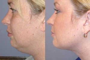 Necklift with Nizar Merheb MD