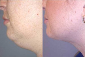 Necklift with Nizar Merheb MD