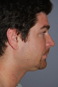 Necklift with Nizar Merheb MD