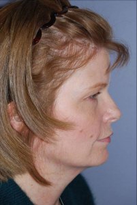 Necklift with Nizar Merheb MD