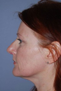 Rhinoplasty with Nizar Merheb MD