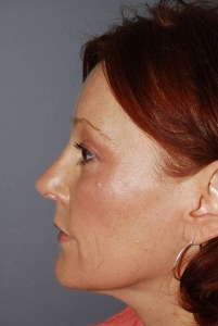 Rhinoplasty with Nizar Merheb MD
