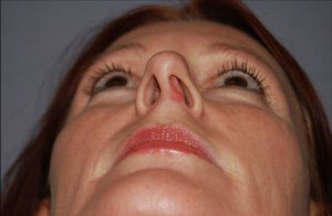 Rhinoplasty with Nizar Merheb MD
