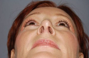 Rhinoplasty with Nizar Merheb MD