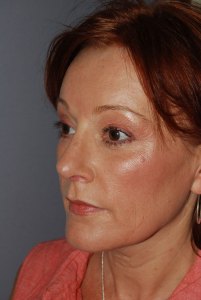 Rhinoplasty with Nizar Merheb MD