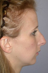 Rhinoplasty with Nizar Merheb MD