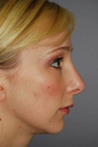 Rhinoplasty with Nizar Merheb MD