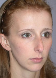 Rhinoplasty with Nizar Merheb MD