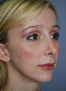 Rhinoplasty with Nizar Merheb MD
