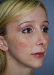 Rhinoplasty with Nizar Merheb MD