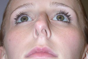Rhinoplasty with Nizar Merheb MD