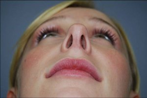Rhinoplasty with Nizar Merheb MD