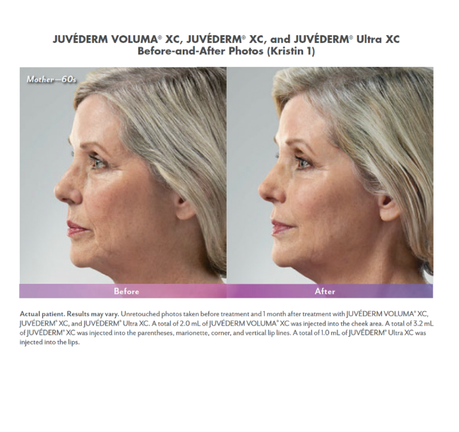 Juvéderm Voluma® with Nizar Merheb MD, DDS, FACS
