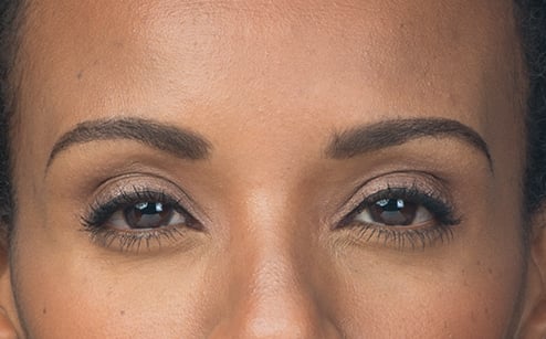After photo of BOTOX® Cosmetic - forehead