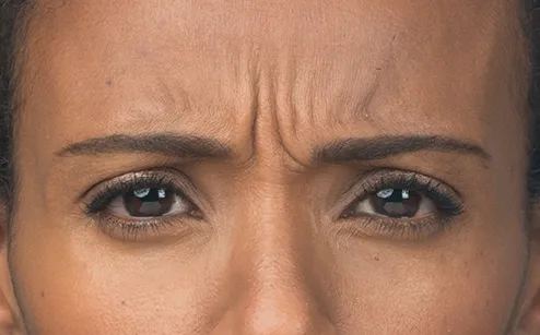 Before photo of BOTOX® Cosmetic - forehead