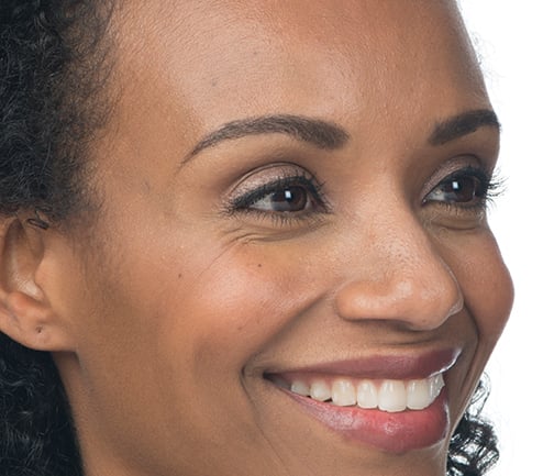 After photo of BOTOX® Cosmetic - face