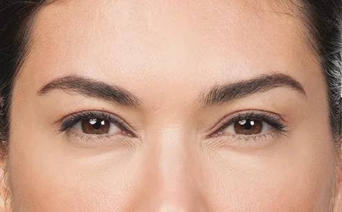 After photo of BOTOX® Cosmetic - forehead