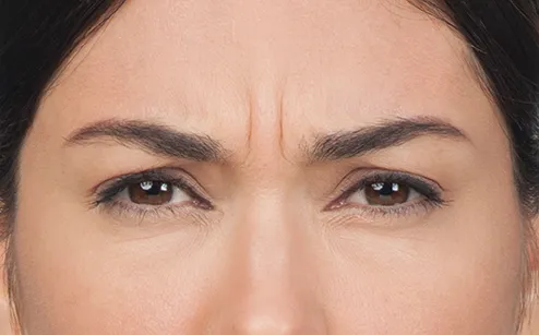 Before photo of BOTOX® Cosmetic - forehead