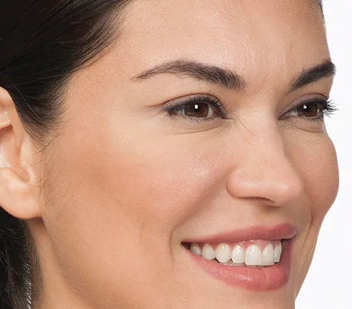 After photo of BOTOX® Cosmetic - face