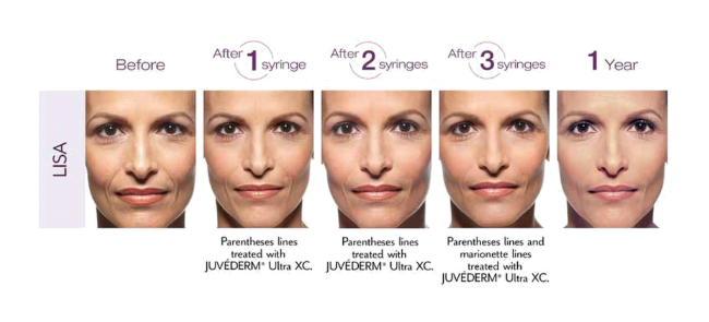Timeline of a patient's face with Juvederm treatment