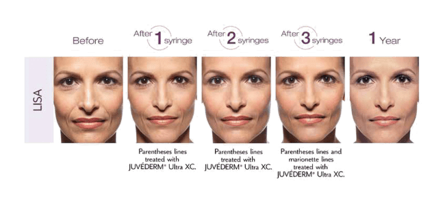 Timeline of a patient's face with Juvederm treatment