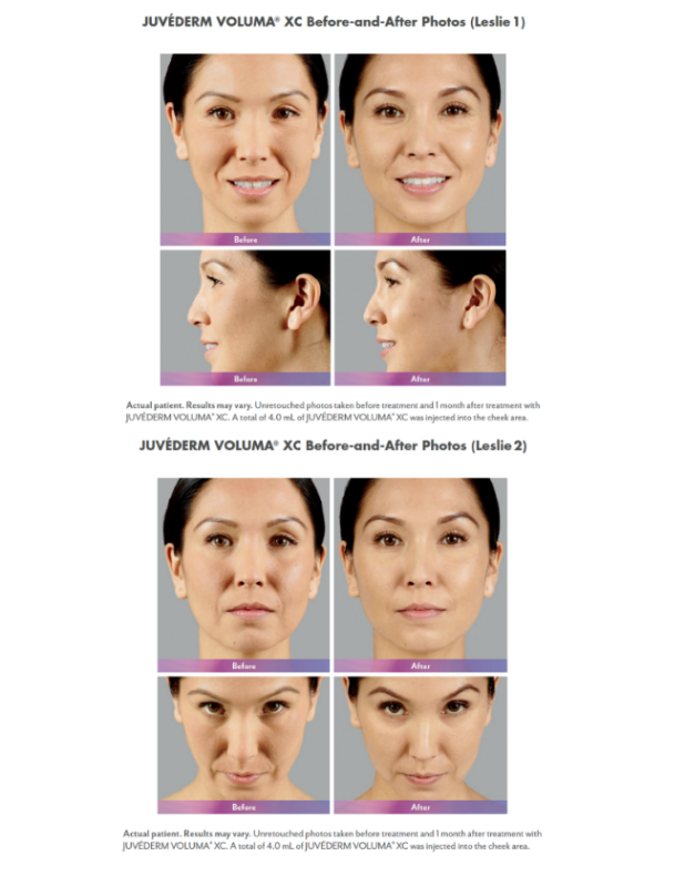 Juvéderm Voluma® with Nizar Merheb MD, DDS, FACS