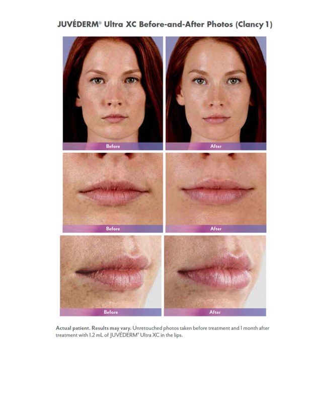 Before and after photo of Juvederm Ultra XC