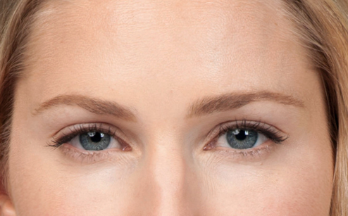 After photo of BOTOX® Cosmetic - forehead