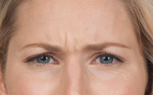 Before photo of BOTOX® Cosmetic - forehead