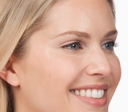 After photo of BOTOX® Cosmetic - face