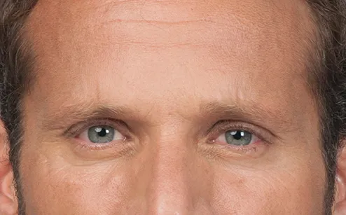 After photo of BOTOX® Cosmetic - forehead