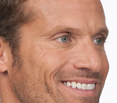After photo of BOTOX® Cosmetic - face