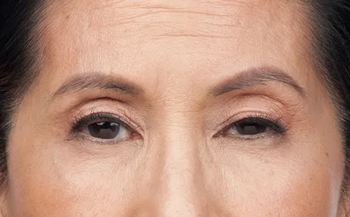 After photo of BOTOX® Cosmetic - forehead