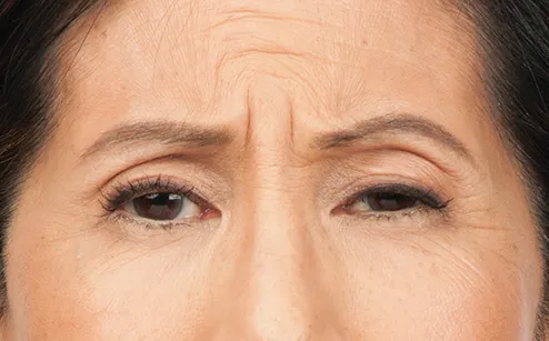 Before photo of BOTOX® Cosmetic - forehead