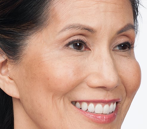 After photo of BOTOX® Cosmetic - face