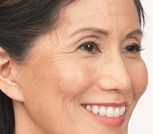 Before photo of BOTOX® Cosmetic - face