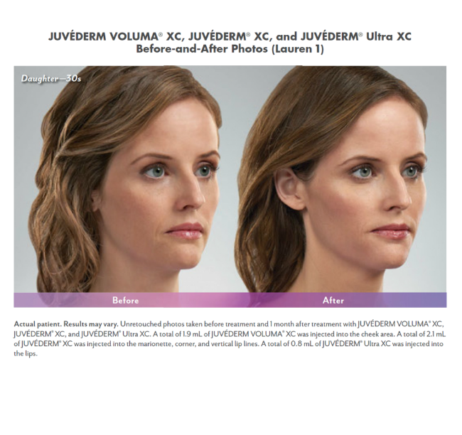 Juvéderm Voluma® with Nizar Merheb MD, DDS, FACS