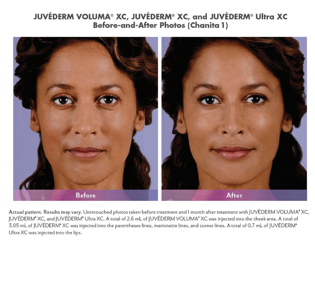 Juvéderm Voluma® with Nizar Merheb MD, DDS, FACS
