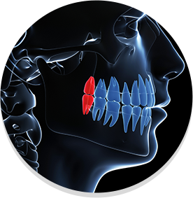 Digital side view of a person's teeth with the wisdom teeth highlighted in red