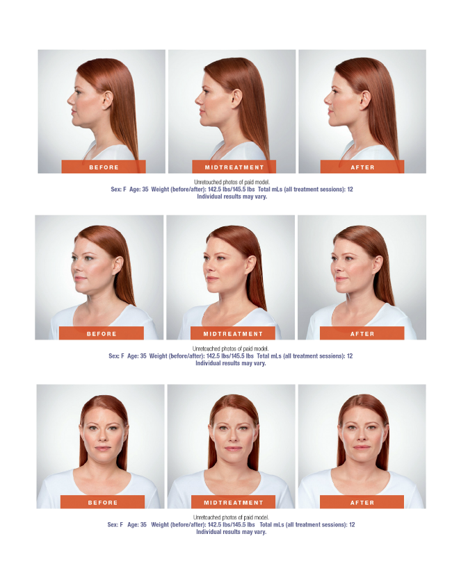 Kybella injection with Nizar Merheb MD, DDS, FACS