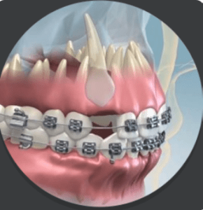 Digital image of an impacted teeth