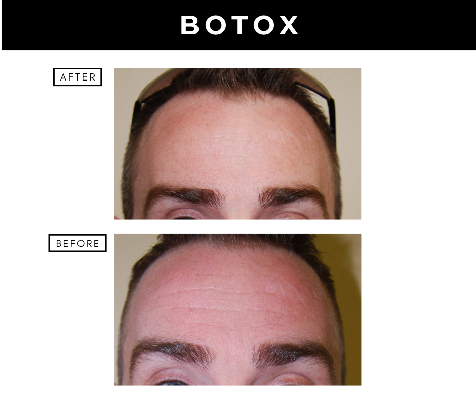 Botox cosmetic – patients of Dr. Nizar Merheb