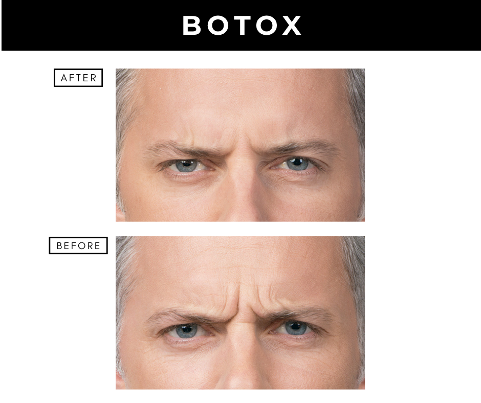Botox cosmetic – patients of Dr. Nizar Merheb